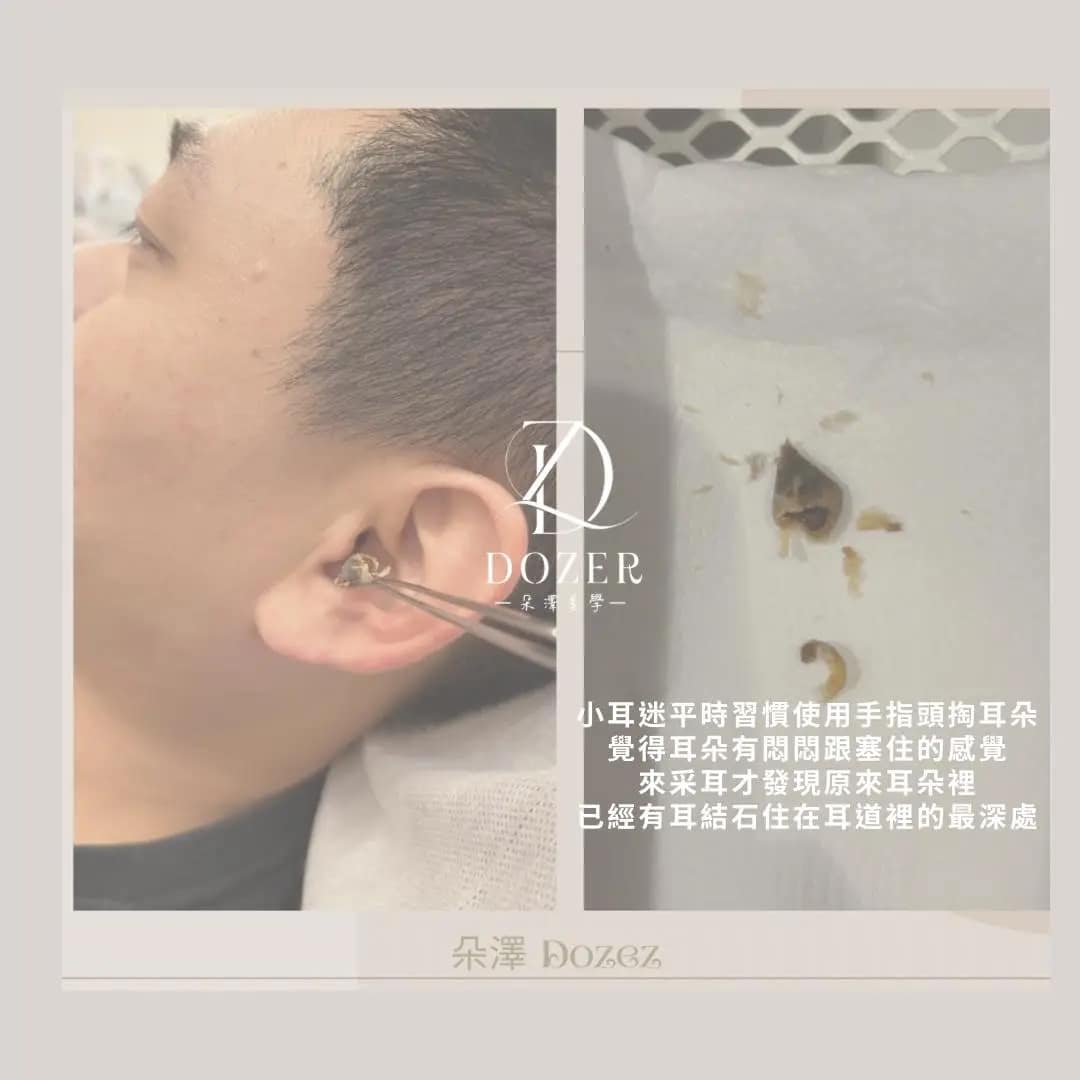 您多久沒有挖耳朵了？